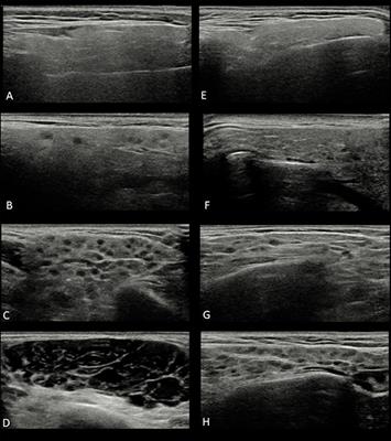 Salivary Gland Ultrasonography in Sjögren's Syndrome: A European Multicenter Reliability Exercise for the HarmonicSS Project